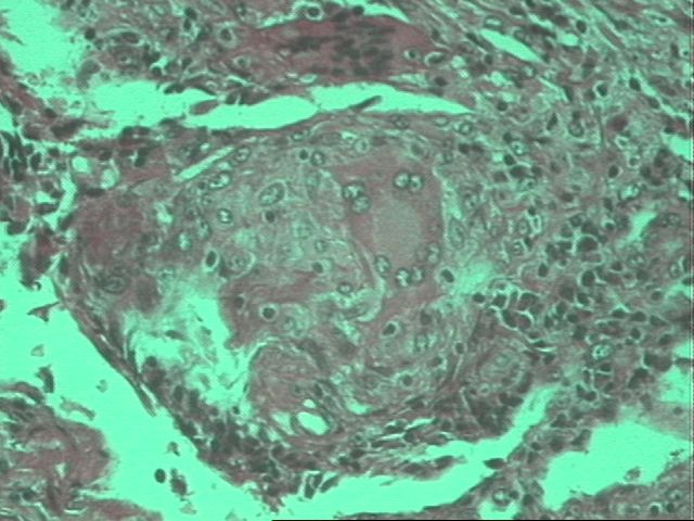 Figura 9 - Lesion granulomatosa caracteristica de la Sarcoidosis con celulas gigantes de tipo Langhans a mediano aumento (10x) con la coloracion de H/E.